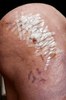 Why Steri-Strips Might Be the Most Underrated Tool in Your First Aid Kit