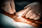 Hands applying Steri-Strips on a patient’s skin during a medical procedure.