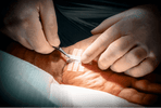 Hands applying Steri-Strips on a patient’s skin during a medical procedure.