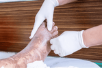 Burn First Aid Made Simple: How to Use Burn Gel Dressings Effectively in the Outdoors
