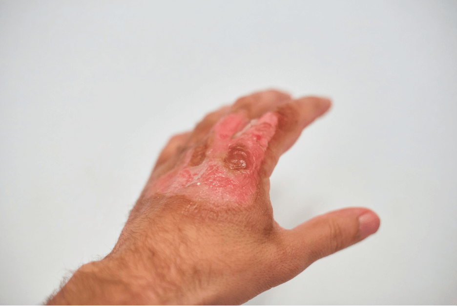 Burn Gel Dressings for Burns: Fast Relief and Outdoor First Aid