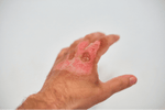 Burn Gel Dressings for Burns: Fast Relief and Outdoor First Aid