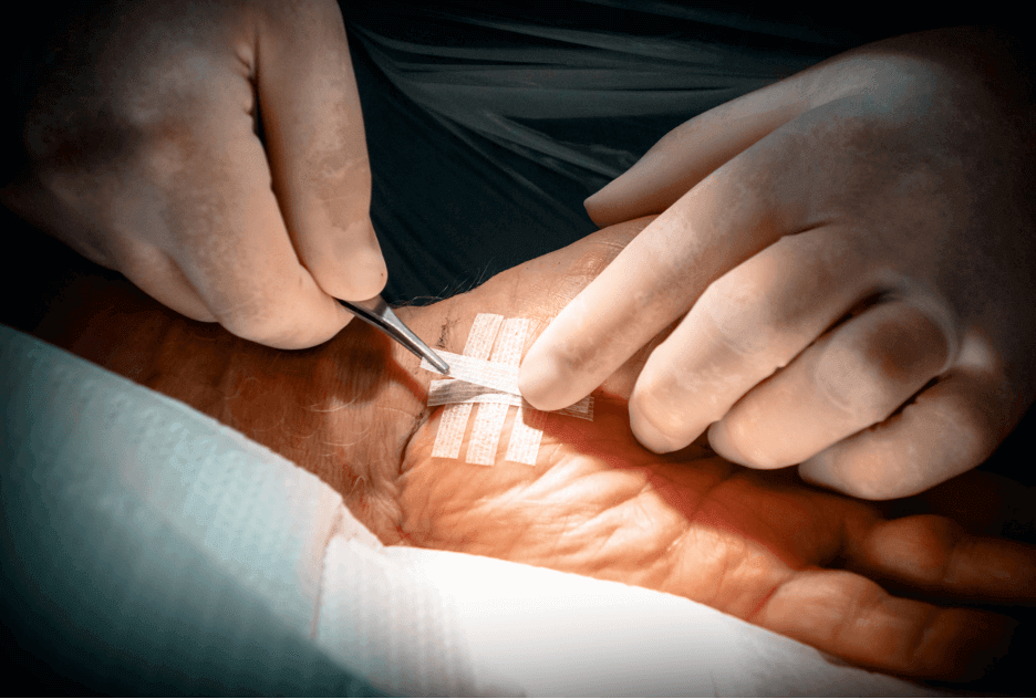 Hands applying Steri-Strips on a patient’s skin during a medical procedure.