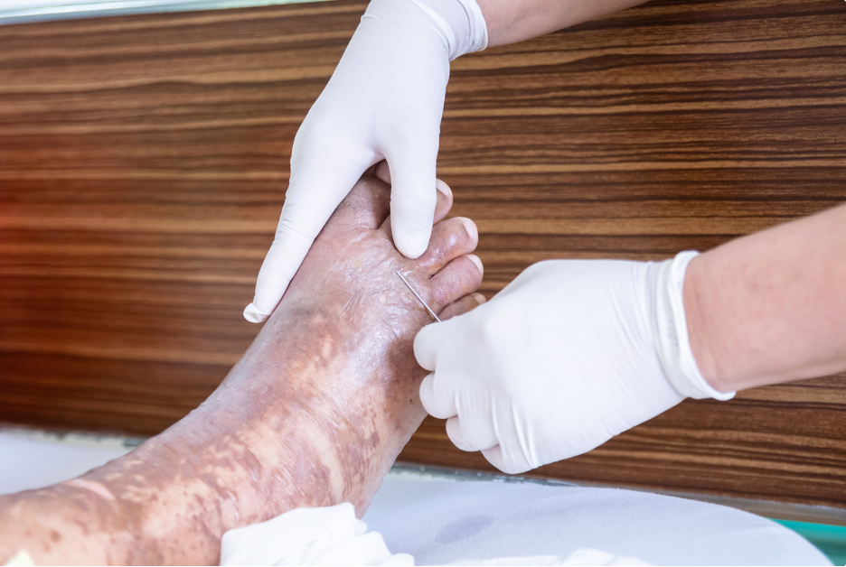 Burn Care Basics: Using Burn Gel Dressings Effectively