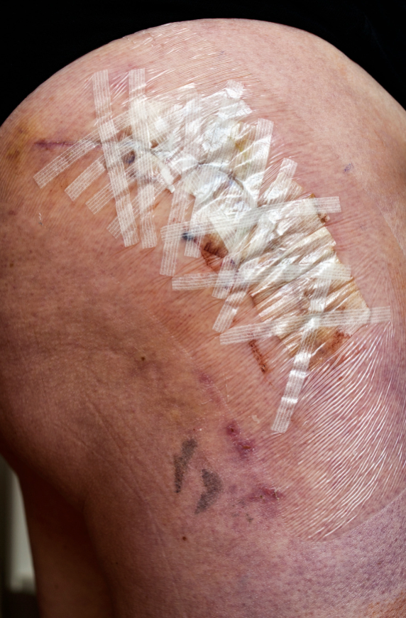 Why Steri-Strips Might Be the Most Underrated Tool in Your First Aid Kit
