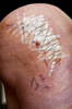 Why Steri-Strips Might Be the Most Underrated Tool in Your First Aid Kit