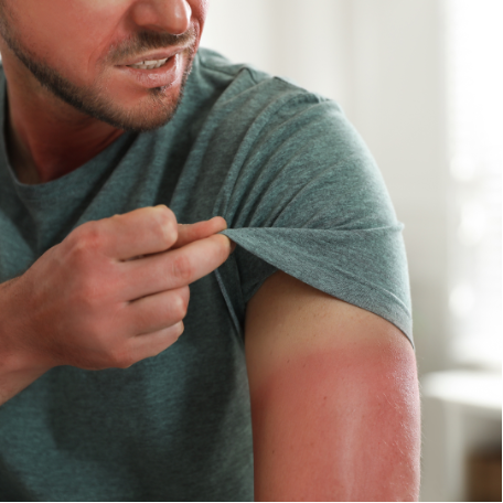 Sunburn Treatment and Prevention for the Unseasonably Warm Days