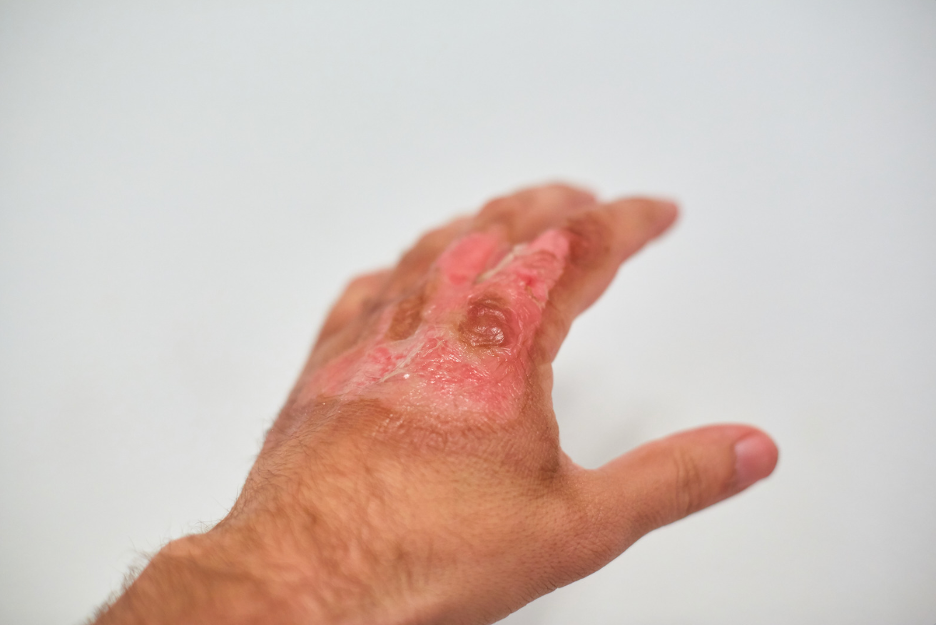 Burn Gel Dressings for Burns: Fast Relief and Outdoor First Aid