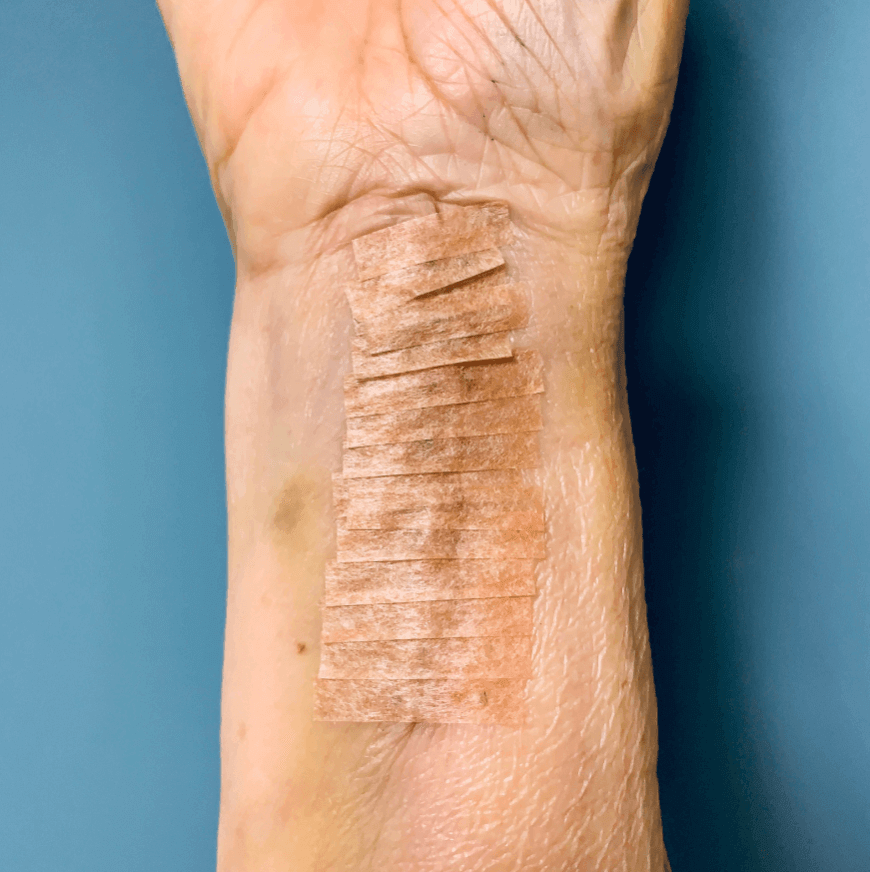 Butterfly Strips vs. Traditional Stitches - What You Need to Know: butterfly strips applied on a forearm wound.