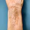 Butterfly Strips vs. Traditional Stitches - What You Need to Know: butterfly strips applied on a forearm wound.